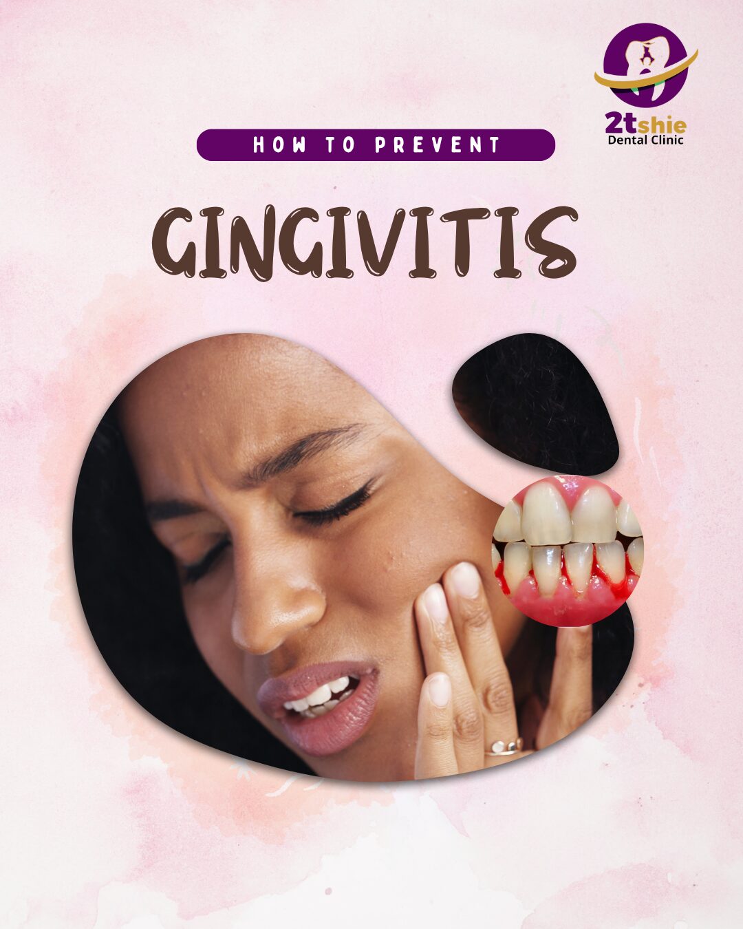 2tshie - How to Prevent Gingivitis